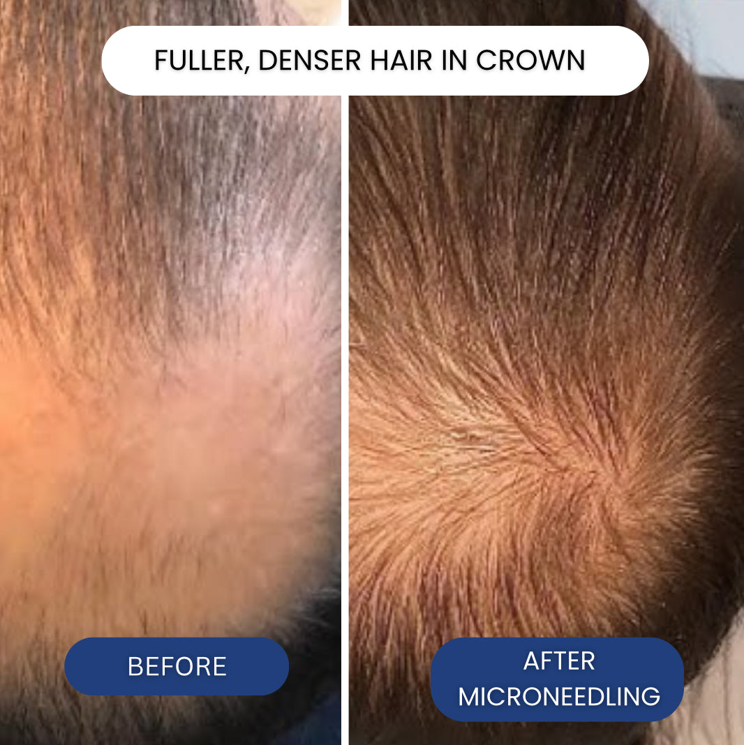 Micro-Infusion Copper Peptide System For Hair Regrowth