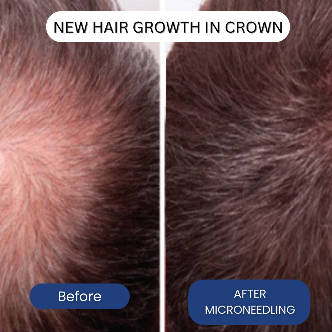 Micro-Infusion Copper Peptide System For Hair Regrowth